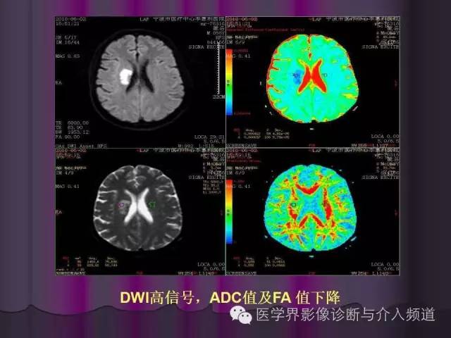 【PPT】联合应用DWI与DTI技术诊断缺血性小卒中及评估其预后