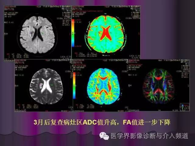【PPT】联合应用DWI与DTI技术诊断缺血性小卒中及评估其预后