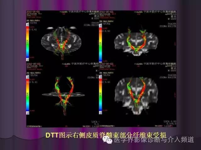 【PPT】联合应用DWI与DTI技术诊断缺血性小卒中及评估其预后