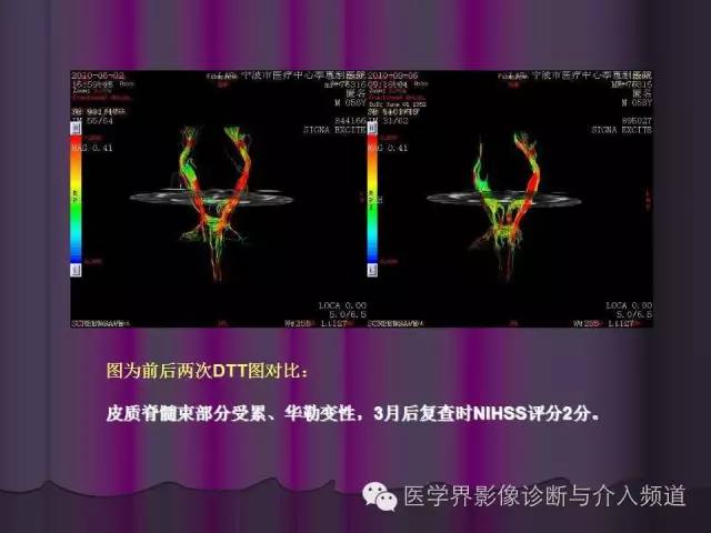 【PPT】联合应用DWI与DTI技术诊断缺血性小卒中及评估其预后