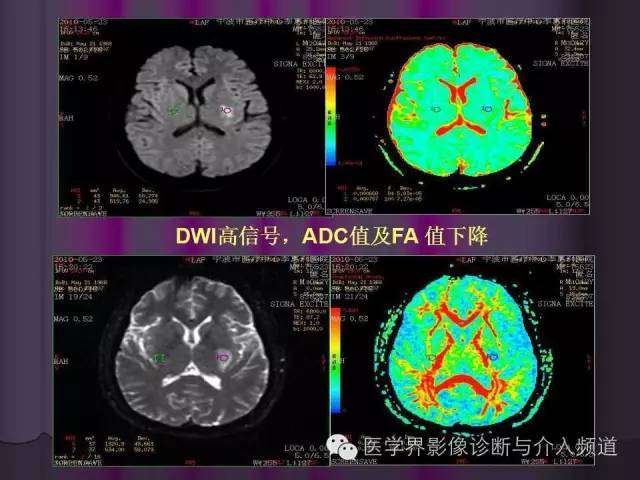 【PPT】联合应用DWI与DTI技术诊断缺血性小卒中及评估其预后