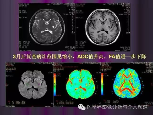 【PPT】联合应用DWI与DTI技术诊断缺血性小卒中及评估其预后