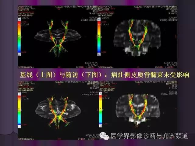 【PPT】联合应用DWI与DTI技术诊断缺血性小卒中及评估其预后