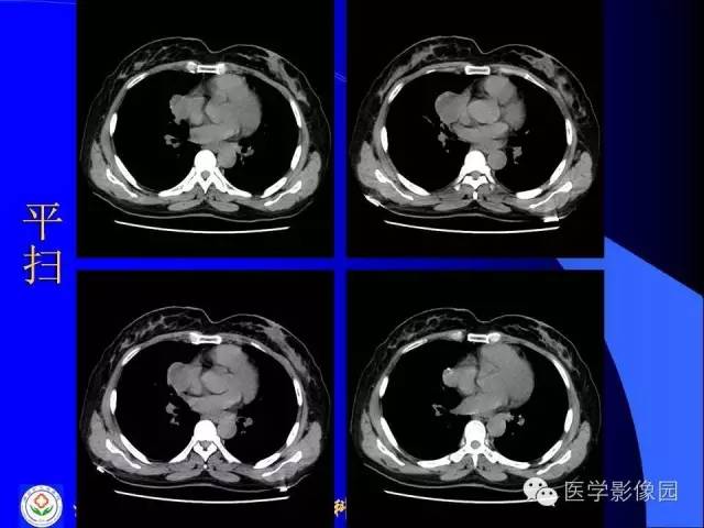 【病例】异位胸腺瘤1例CT影像表现