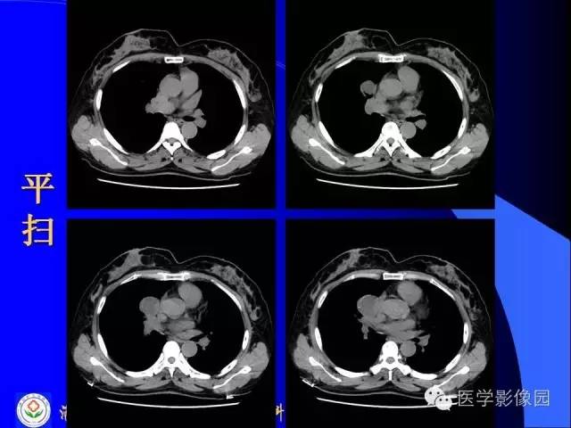 【病例】异位胸腺瘤1例CT影像表现