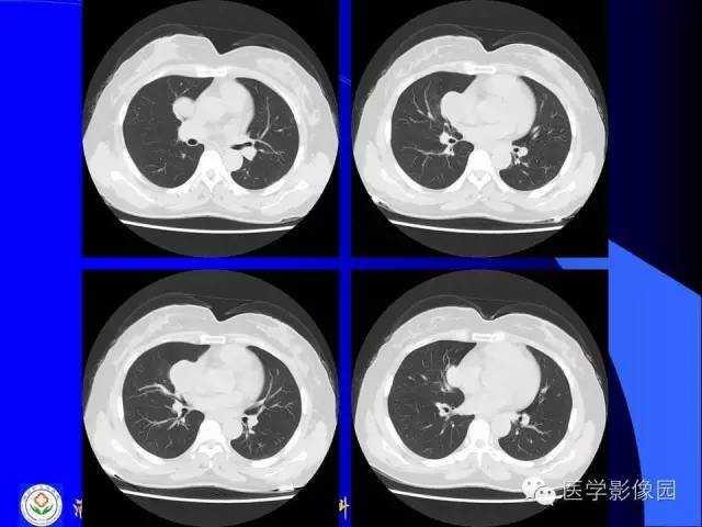 【病例】异位胸腺瘤1例CT影像表现