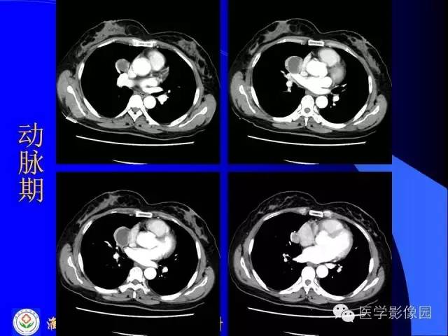 【病例】异位胸腺瘤1例CT影像表现
