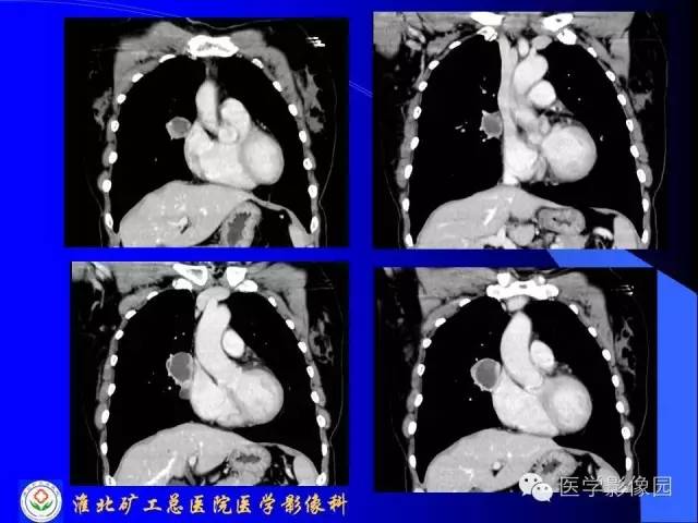 【病例】异位胸腺瘤1例CT影像表现