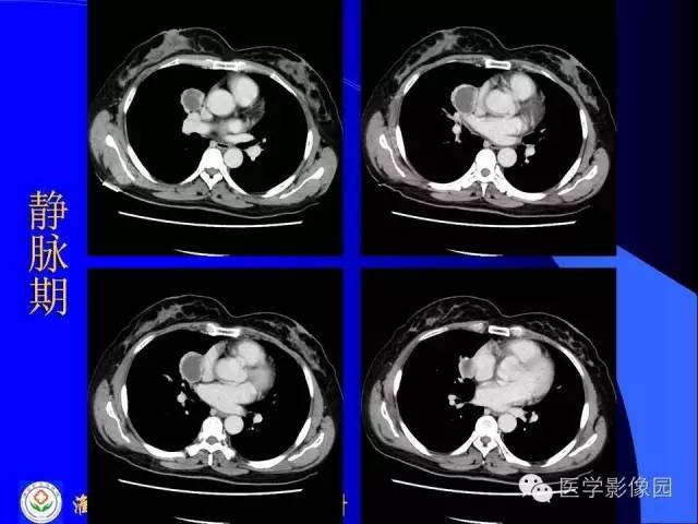 【病例】异位胸腺瘤1例CT影像表现