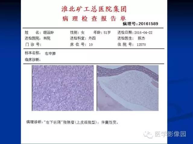 【病例】异位胸腺瘤1例CT影像表现