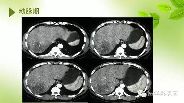 【病例】肝细胞性肝癌伴坏死1例CT影像表现