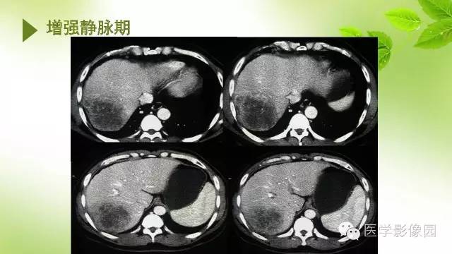 【病例】肝细胞性肝癌伴坏死1例CT影像表现