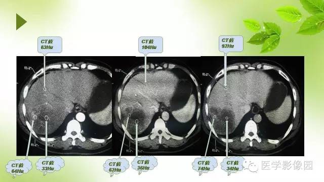 【病例】肝细胞性肝癌伴坏死1例CT影像表现