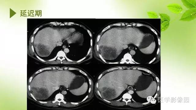 【病例】肝细胞性肝癌伴坏死1例CT影像表现