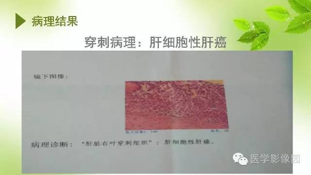 【病例】肝细胞性肝癌伴坏死1例CT影像表现