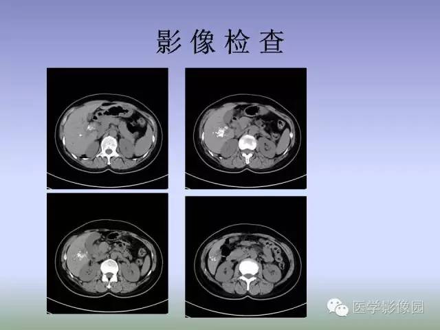 【病例】肝脏结核1例CT影像表现