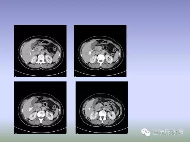 【病例】肝脏结核1例CT影像表现