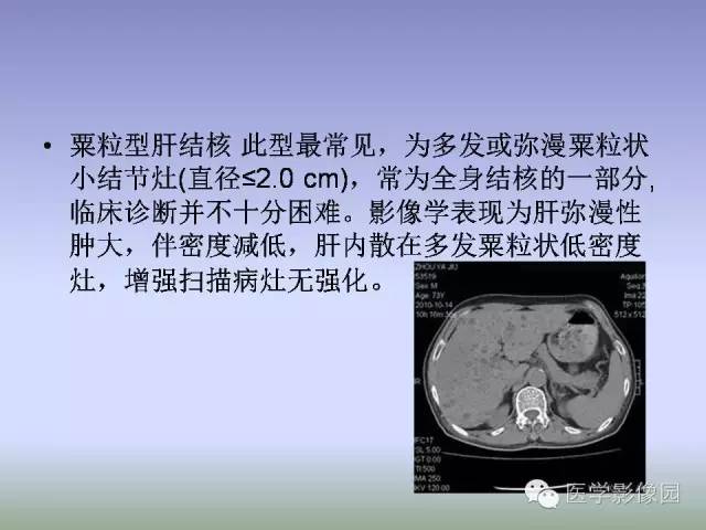 【病例】肝脏结核1例CT影像表现