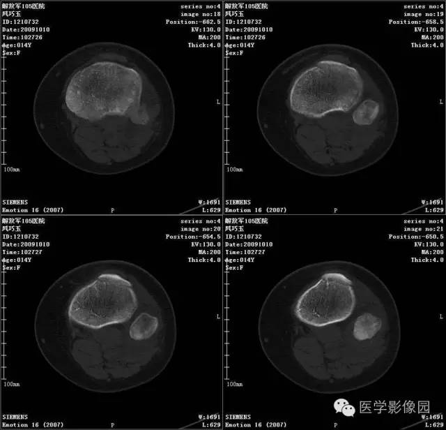 【病例】腓骨骨肉瘤1例CT影像表现 【病例】腓骨骨肉瘤1例CT影像表现