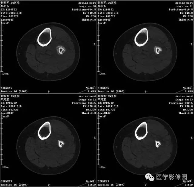 【病例】腓骨骨肉瘤1例CT影像表现 【病例】腓骨骨肉瘤1例CT影像表现