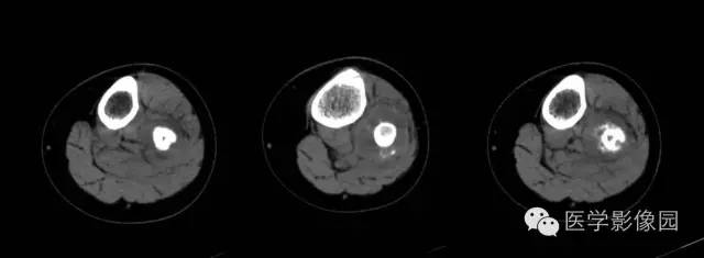 【病例】腓骨骨肉瘤1例CT影像表现 【病例】腓骨骨肉瘤1例CT影像表现