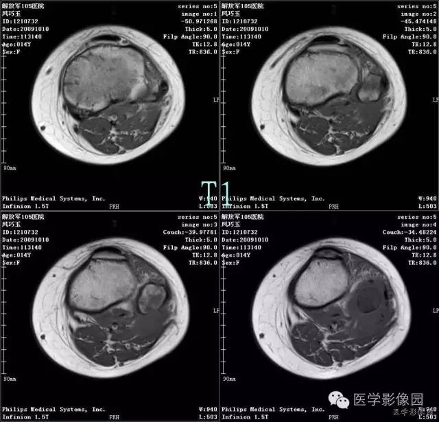 【病例】腓骨骨肉瘤1例CT影像表现 【病例】腓骨骨肉瘤1例CT影像表现