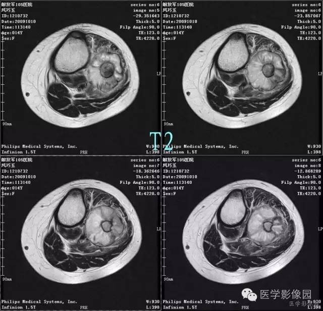 【病例】腓骨骨肉瘤1例CT影像表现 【病例】腓骨骨肉瘤1例CT影像表现