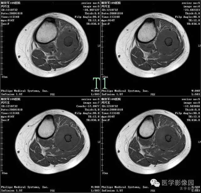 【病例】腓骨骨肉瘤1例CT影像表现 【病例】腓骨骨肉瘤1例CT影像表现