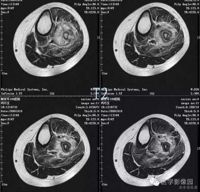 【病例】腓骨骨肉瘤1例CT影像表现 【病例】腓骨骨肉瘤1例CT影像表现