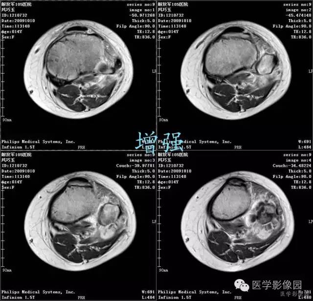 【病例】腓骨骨肉瘤1例CT影像表现 【病例】腓骨骨肉瘤1例CT影像表现