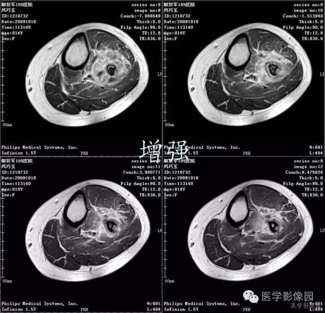 【病例】腓骨骨肉瘤1例CT影像表现 【病例】腓骨骨肉瘤1例CT影像表现
