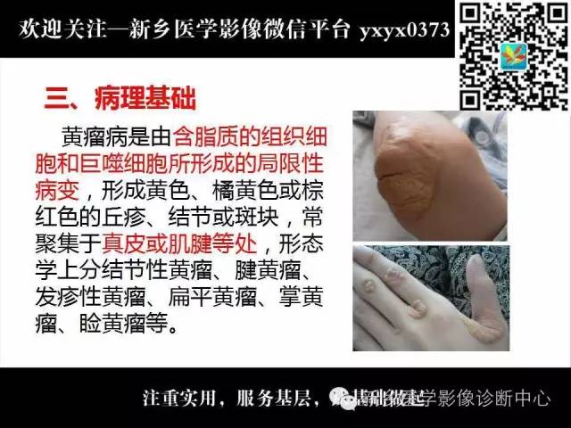 【PPT】脑腱黄瘤病