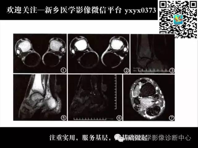 【PPT】脑腱黄瘤病