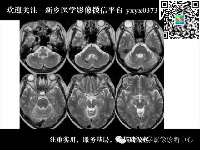 【PPT】脑腱黄瘤病