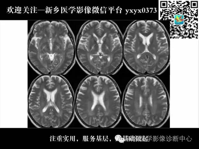 【PPT】脑腱黄瘤病