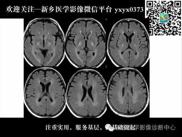 【PPT】脑腱黄瘤病