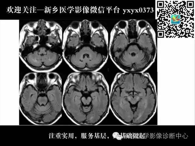 【PPT】脑腱黄瘤病