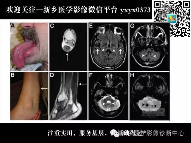 【PPT】脑腱黄瘤病