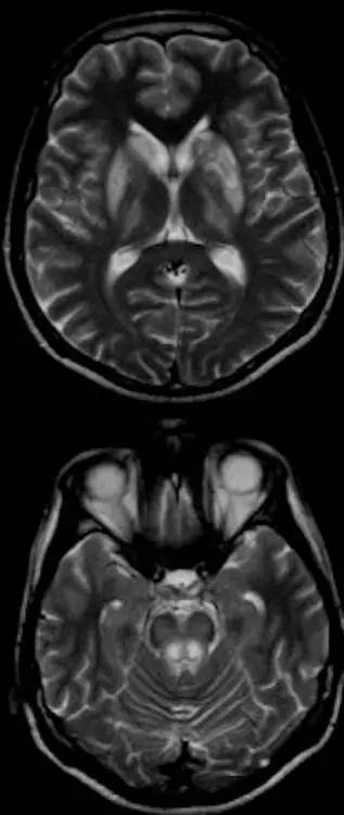 肝豆状核变性Wilson Disease的影像学表现