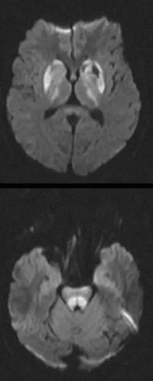 肝豆状核变性Wilson Disease的影像学表现 肝豆状核变性Wilson Disease的影像学表现