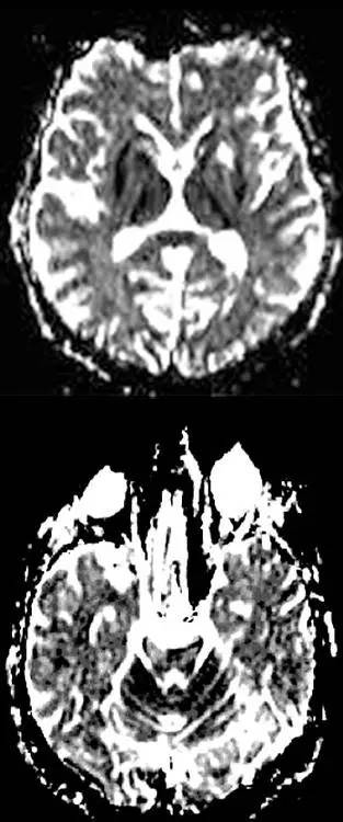 肝豆状核变性Wilson Disease的影像学表现 肝豆状核变性Wilson Disease的影像学表现