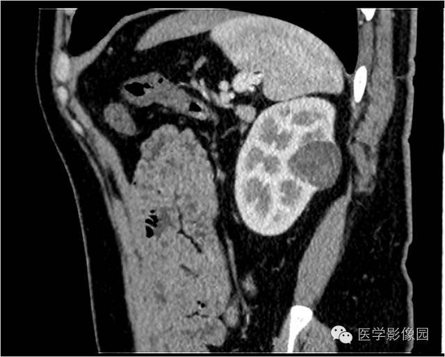 【病例】很多人都诊断错了的肾脏肿瘤——后肾腺瘤1例CT 【病例】很多人都诊断错了的肾脏肿瘤——后肾腺瘤1例CT