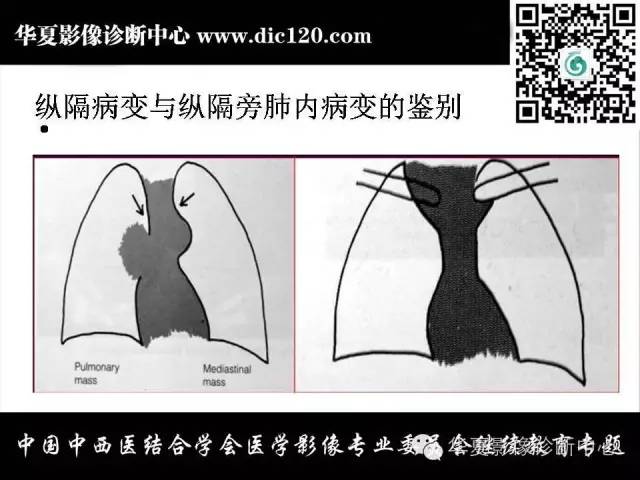 【PPT】纵隔疾病影像诊断和鉴别诊断