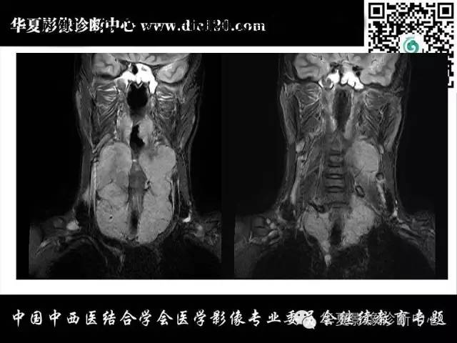 【PPT】纵隔疾病影像诊断和鉴别诊断