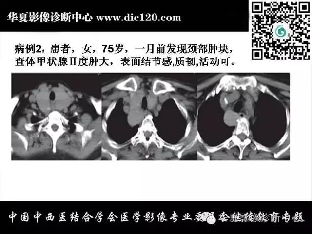 【PPT】纵隔疾病影像诊断和鉴别诊断