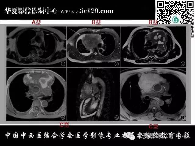 【PPT】纵隔疾病影像诊断和鉴别诊断