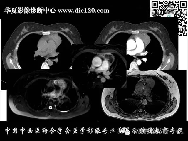 【PPT】纵隔疾病影像诊断和鉴别诊断