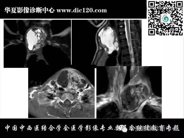 【PPT】纵隔疾病影像诊断和鉴别诊断