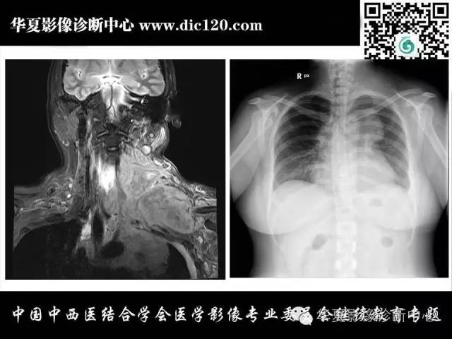 【PPT】纵隔疾病影像诊断和鉴别诊断