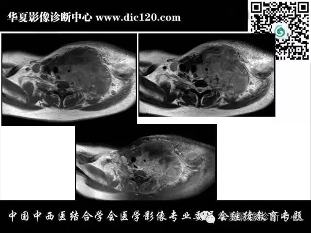 【PPT】纵隔疾病影像诊断和鉴别诊断